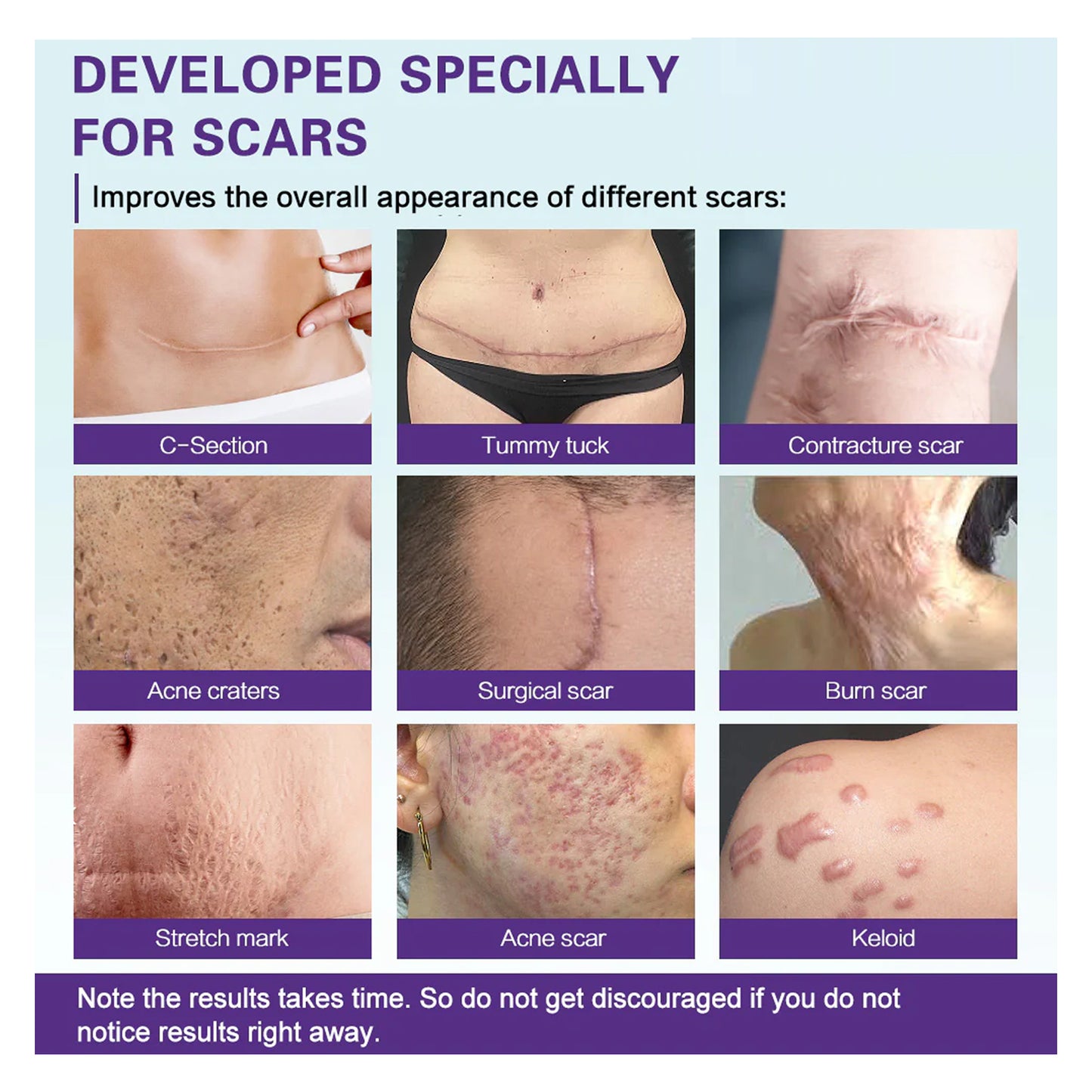 West&Month High-quality Silicone Scar Gel, Lighten Acne Mark Scar Repair Skin Smoothing Care Cream - LaTezza Online Shop
