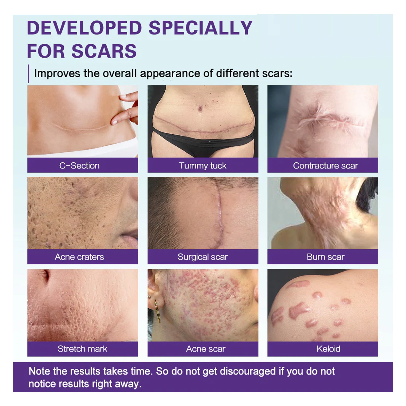 West&Month High-quality Silicone Scar Gel, Lighten Acne Mark Scar Repair Skin Smoothing Care Cream - LaTezza Online Shop
