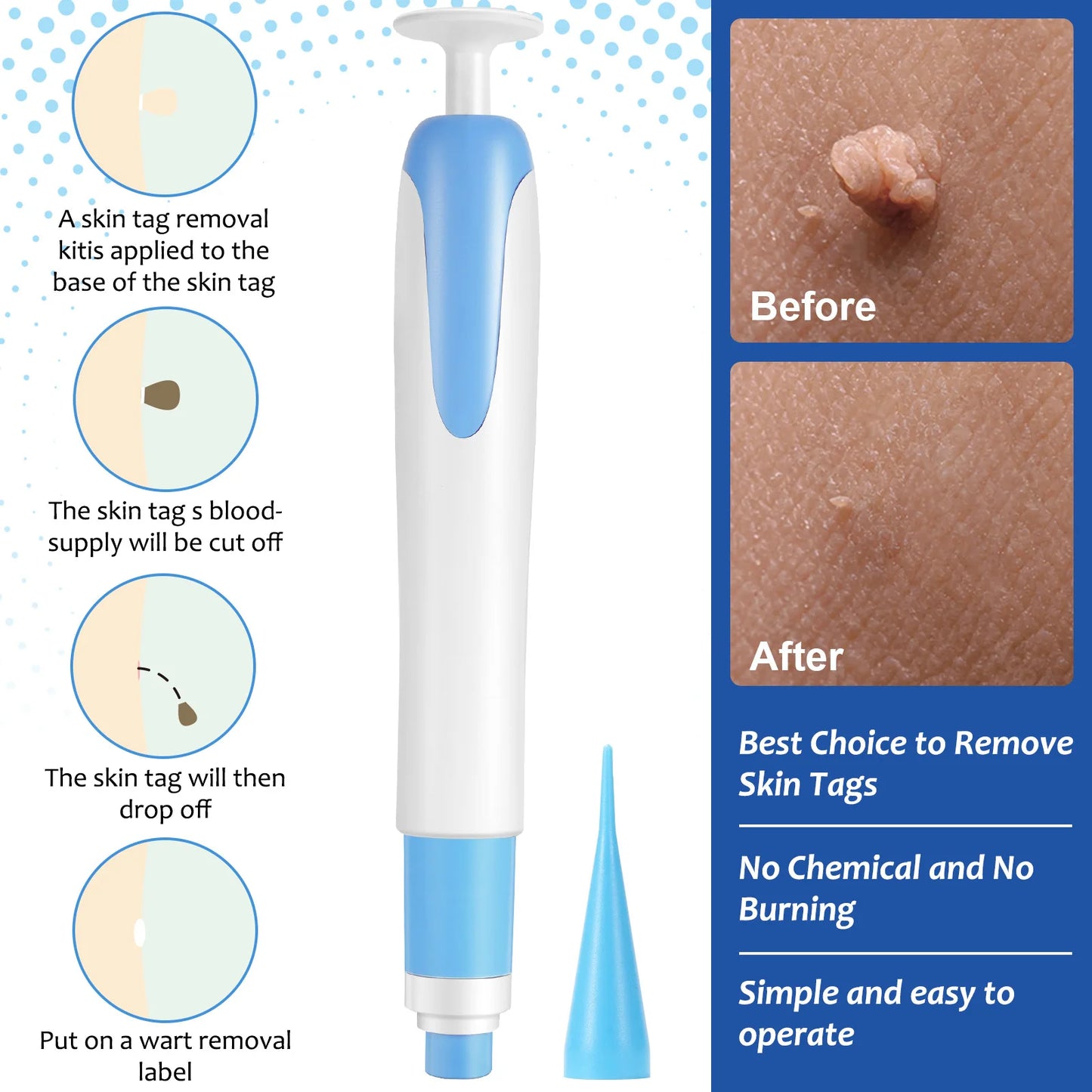 2 In1 Painless Auto Skin Tag Mole Wart Removal Kit Cleaning Tools Face Skin Care Body Wart Dot Treatments Remover Beauty Health