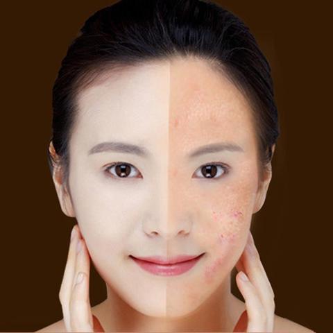 Blue Light Therapy Acne Laser Pen Soft Scar Wrinkle Removal Treatment Device Skin Care Beauty Equipment - LaTezza Online Shop